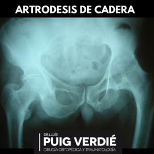 artrodesis de cadera caso paciente Dr. Lluís Puig Verdié traumatólogo experto en cadera y rodilla