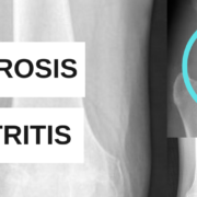 Diferencia entre artrosis y artritis por el Dr. Lluís Puig Verdié traumatólogo experto en prótesis de rodilla y cadera en Barcelona post