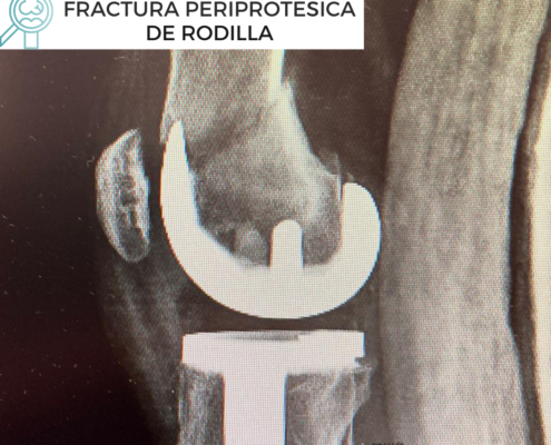 fractura periprotésica de rodilla por el Dr. Lluís Puig Verdié