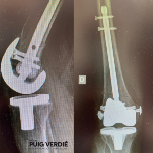 Caso fractura periprotésica de rodilla Dr. Lluís Puig Verdié