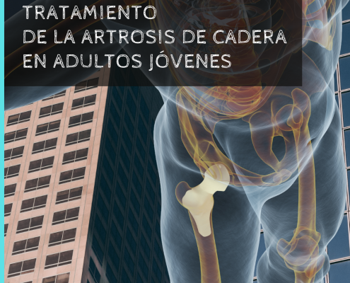 tratamiento de la artrosis en adultos jóvenes por el Dr. Lluís Puig Verdié traumatólgo experto en cirugía de prótesis de cadera