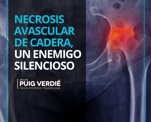 Necrosis avascular de cadera por el Dr. Lluís Puig Verdié Hospital Quirónsalud Barcelona